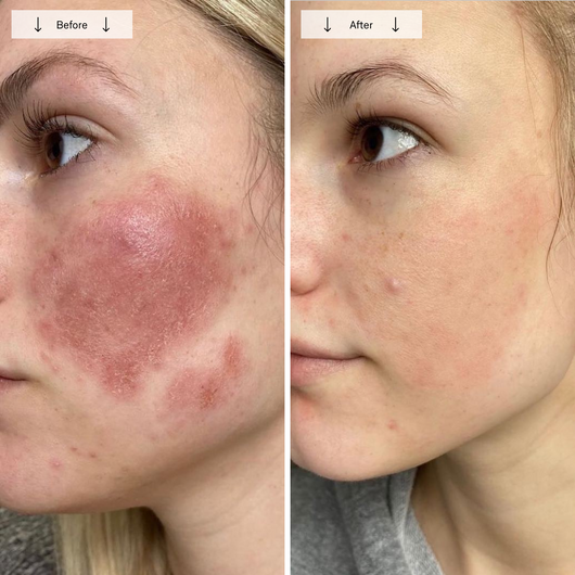Omnilux Contour Face